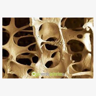 Charla sobre la Osteoporosis